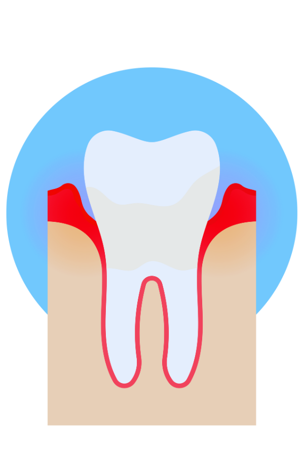 Grafik mit Parodontitisbefall eines Zahns